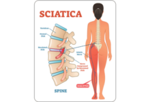 sciatica treatments