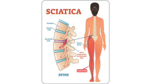 sciatica treatments